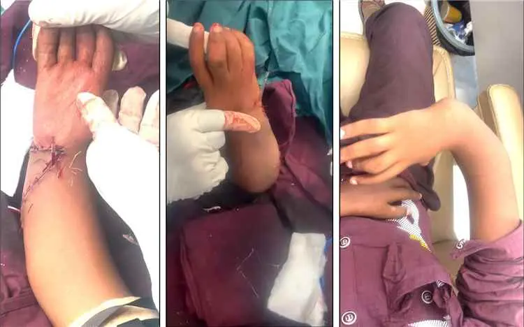 إنجاز طبي غير مسبوق في اليمن.. جراح يمني في عدن ين...