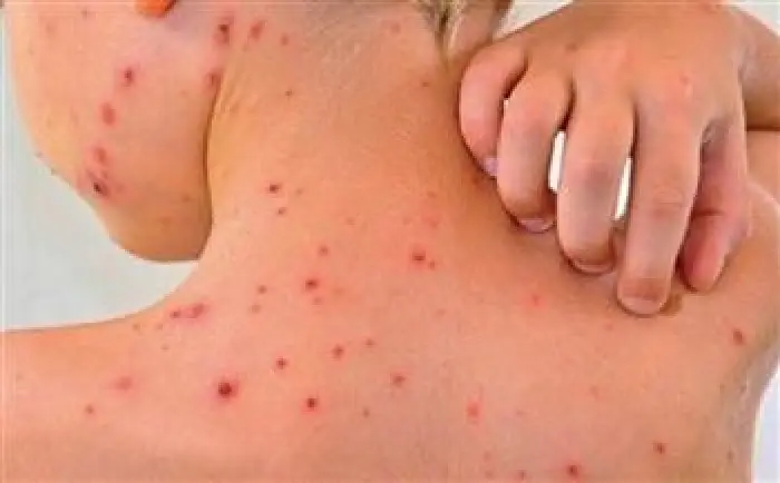 الصحة الماليزية: ارتفاع حاد في إصابات حمى الضنك