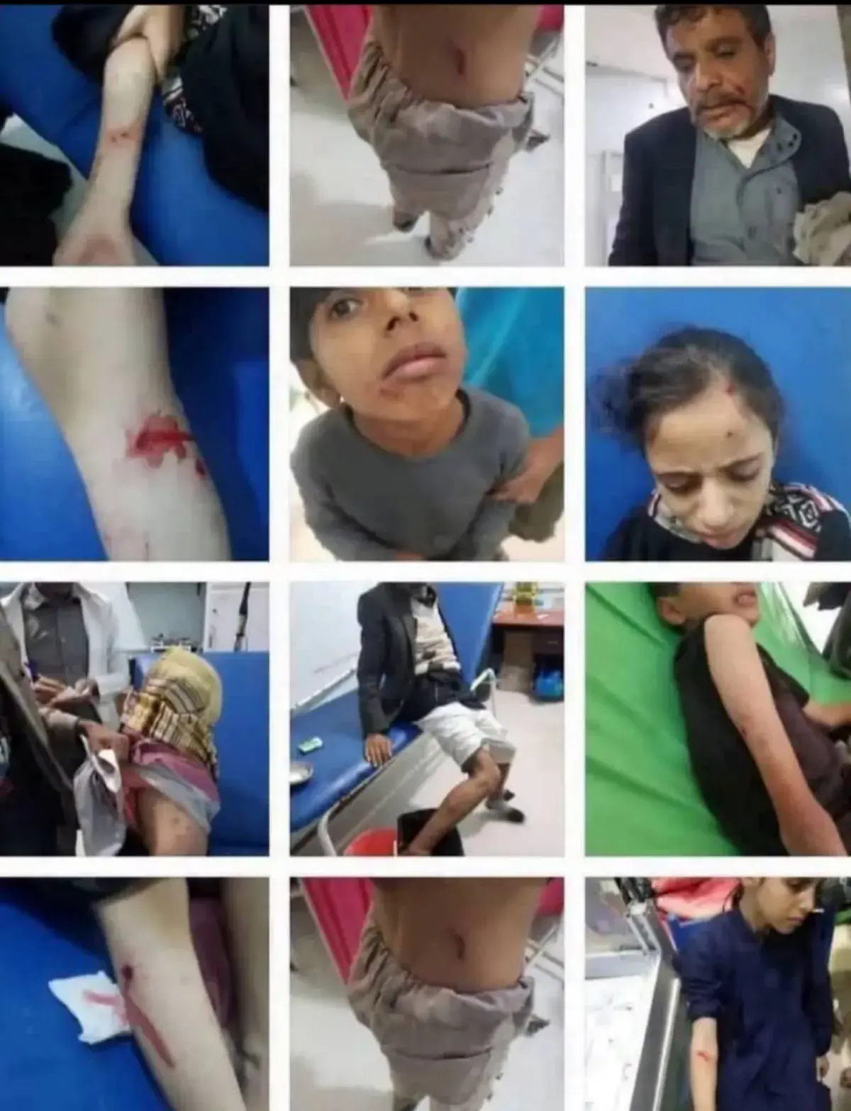 بسبب عبث مليشيا الحوثي بالقطاع الصحي .. إصابة 20 م...