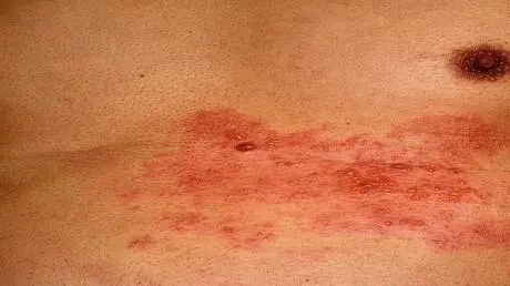 طبيبة تحدد طرقا جديدة لمكافحة الهربس